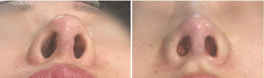 Before and immediately after infection after rhinoplasty revision – nostril view showing improved symmetry and nasal base refinement.