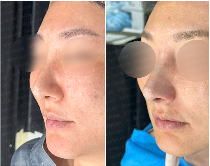 Oblique side view before and immediately after revision rhinoplasty using rib cartilage. Correction of wide nasal base, crooked bridge, and bulbous tip visible in the refined and symmetrical result.