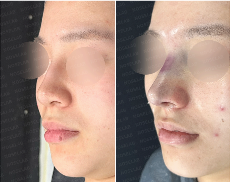 Oblique side view before and after rhinoplasty – enhanced nasal projection, refined bulbous tip, and better contour line.