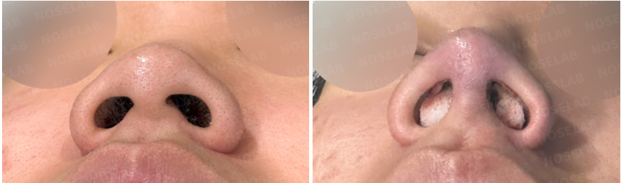 Rhinoplasty Korea – Nostril view before surgery (left) and immediately after surgery (right), showing reduced nostril flare, defined nasal tip, and improved symmetry.