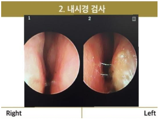 Preoperative nasal endoscopy images showing both right and left nasal passages, used for assessment before secondary rhinoplasty after silicone removal.