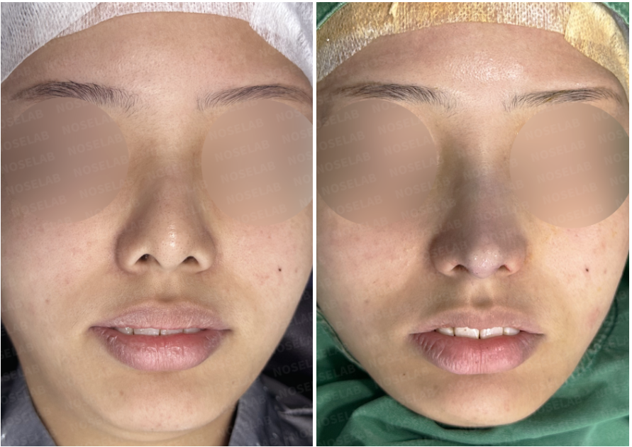 Crooked hump nose correction Korea before and after frontal views showing improved symmetry
