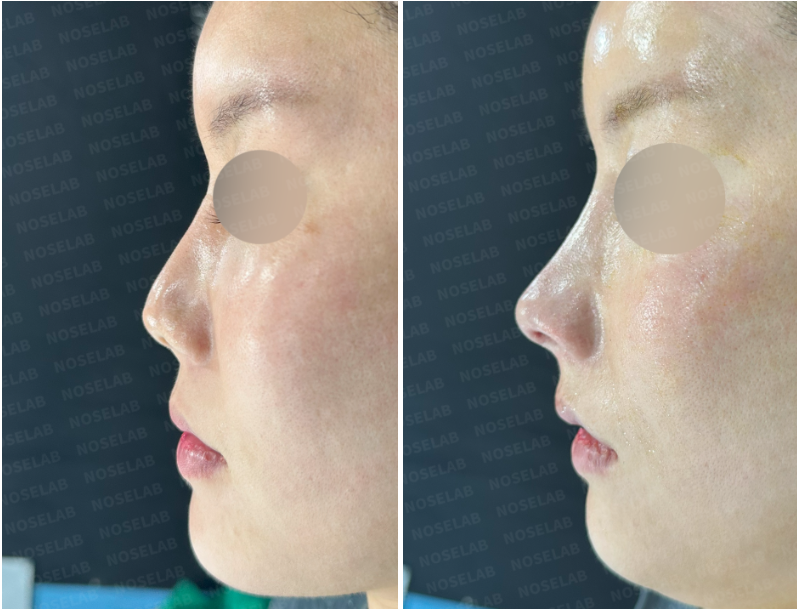 Side profile comparison before and immediately after closed rhinoplasty Korea using rib cartilage — showing corrected nasal projection and tip rotation.