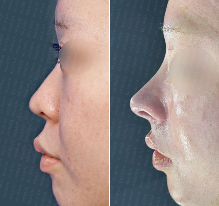Before and immediately after side view comparison demonstrating enhanced nasal bridge height and improved nasolabial angle after rhinoplasty.