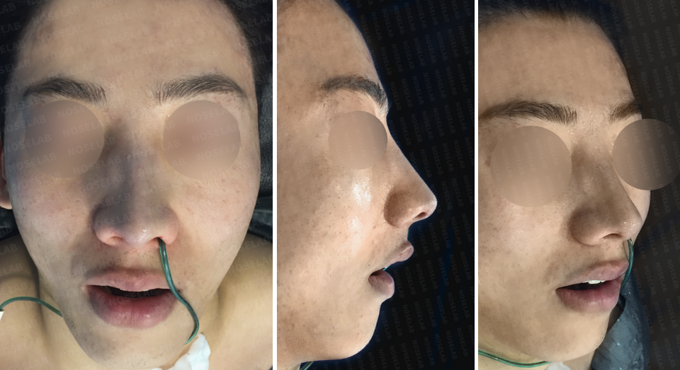 Photos taken immediately after surgery, frontal view, 45-angle view, and side profile.