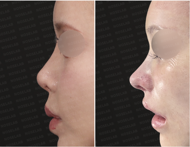 Side before and immediately after views showing nasal tip lengthening and rib cartilage septal reconstruction.