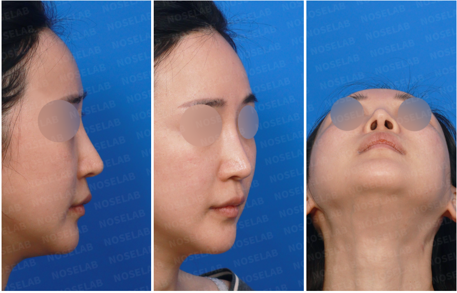 Preoperative consultation photos before structural reconstruction rhinoplasty – right side, right oblique, and nostril views showing nasal base and symmetry before surgery.