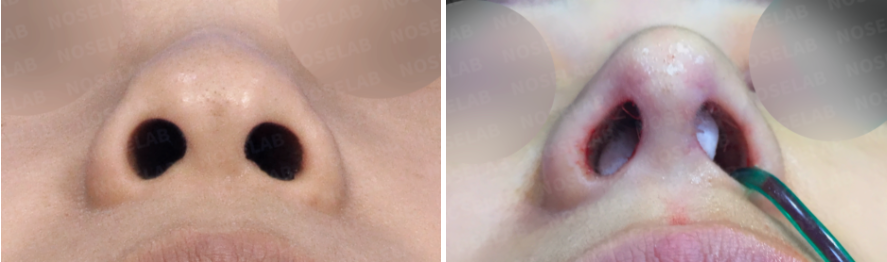 Before and immediately after split nasal tip correction surgery: nostril view comparison.