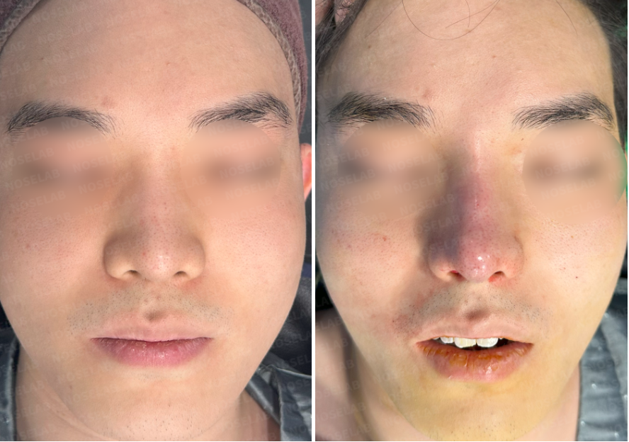 Enhancing nasal height & resolving nasal obstruction – pre- and immediate post-surgery frontal view photos of patient at Nose Lab Clinic.