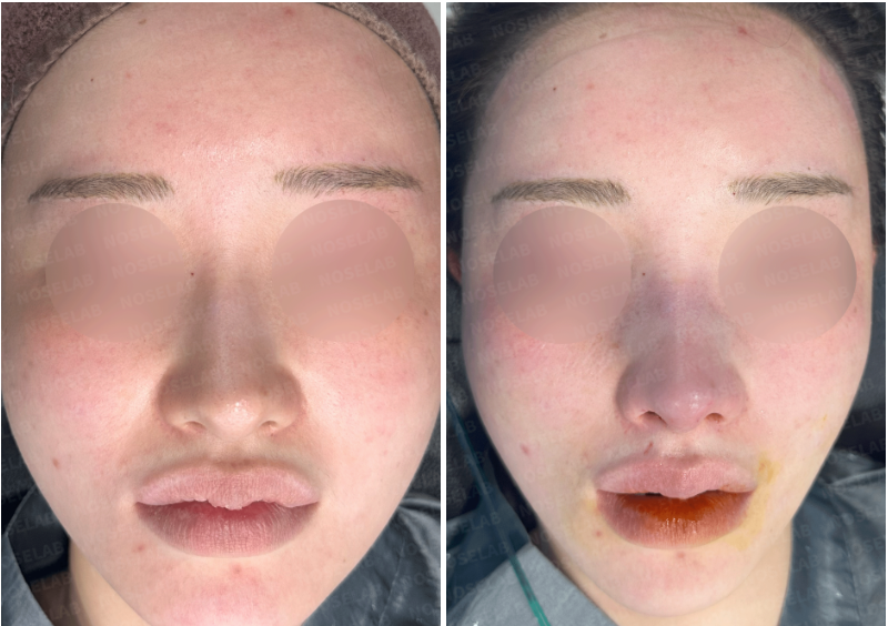 Before and immediately after no-implant nose surgery using autologous rib cartilage: Frontal view showing nasal refinement and swelling.