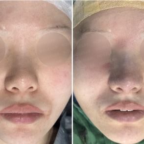 Before and immediately after surgery frontal view showing refinement of bulbous nasal tip, reduction of tip width, and improved nasal definition following revision closed rhinoplasty with rib cartilage reconstruction.