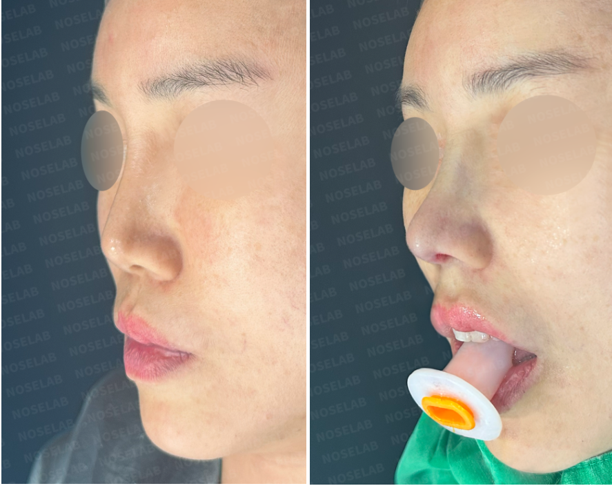 Before and immediately after Medpor removal and septal reconstruction — oblique side view showing balanced nasal projection and natural profile.