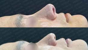 Before and after side view – droopy and bulbous nose correction using self-rib cartilage through closed rhinoplasty (Noselab Clinic)