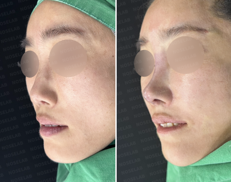 Oblique side view before and after illegal filler removal and total septal reconstruction with autologous rib cartilage — left: before surgery, right: immediately after surgery.
