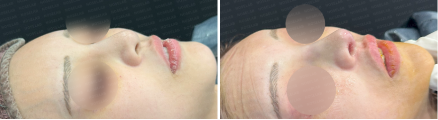 Before and after mesh removal rhinoplasty: oblique side view highlighting refined nasal contour and smoother profile
