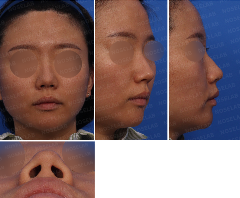 Upturned nose correction Korea preoperative frontal, profile, oblique, and nostril views