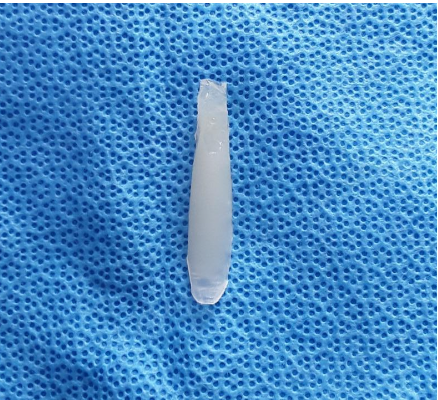 Removed silicone implant from a contracted nose reconstruction case, illustrating the cause of internal scarring and nasal collapse.