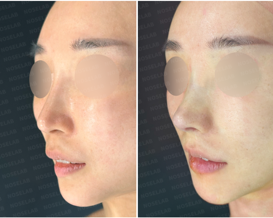 Before and immediately after structural reconstruction rhinoplasty – oblique side view showing refined nasal tip projection, smooth dorsal contour, and natural facial balance.