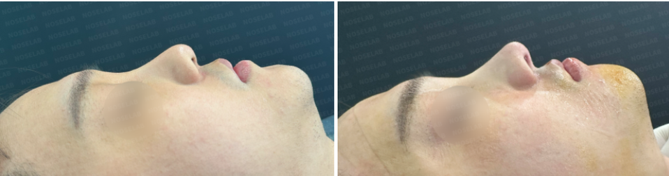Before surgery (left), After surgery (right)
