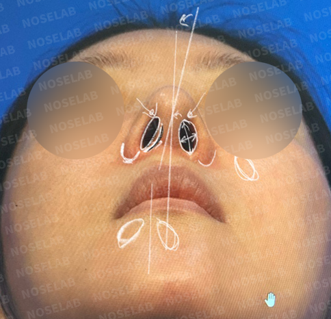 Basal view examination revealing nostril size discrepancy and columellar positioning before secondary nose surgery