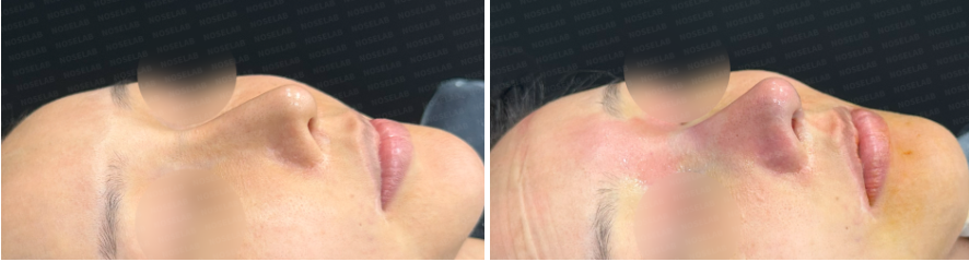 Rhinoplasty for long mid-face correction – before (left) and after (right) oblique view photos