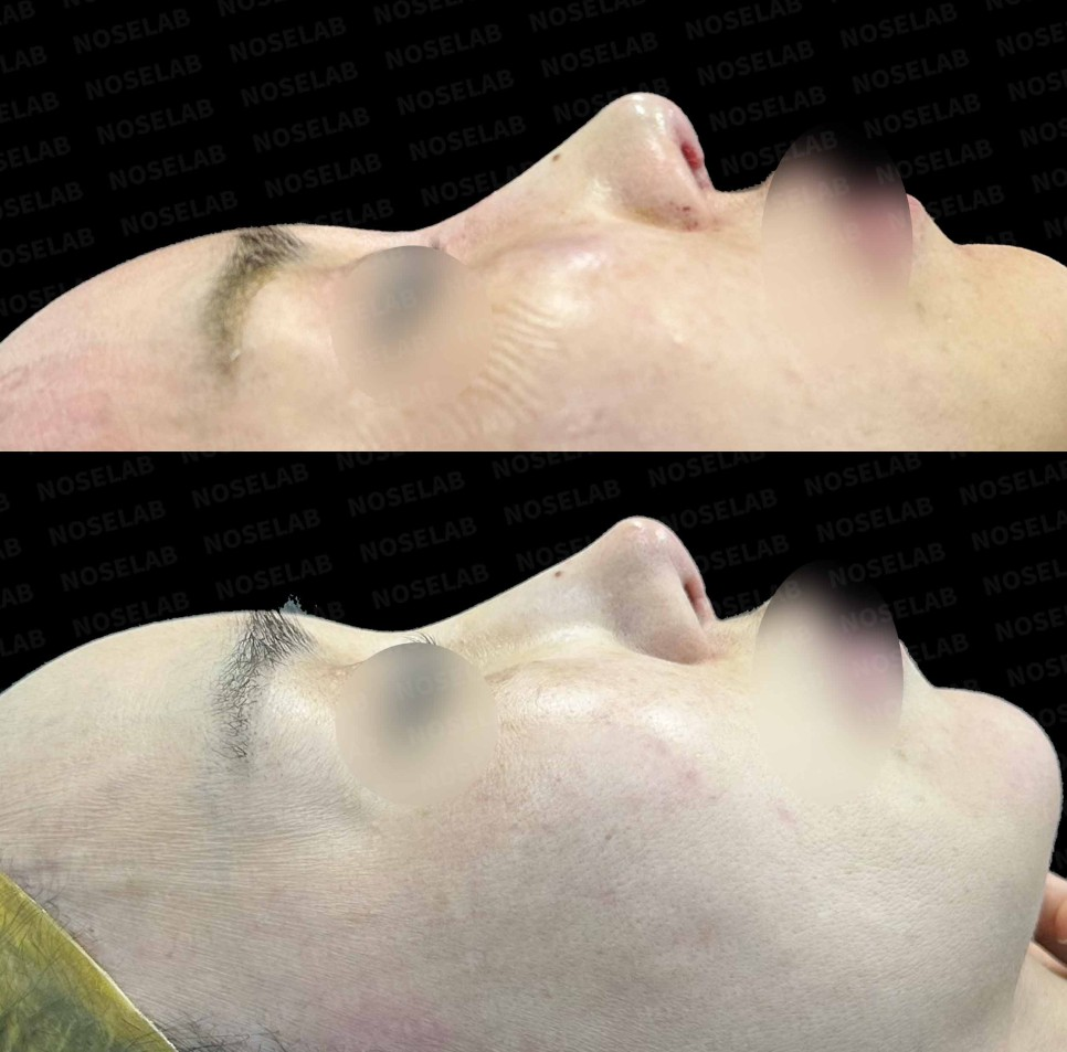 Before and after side view – long and deviated nose correction with visible cartilage improvement through closed revision rhinoplasty (Noselab Clinic)