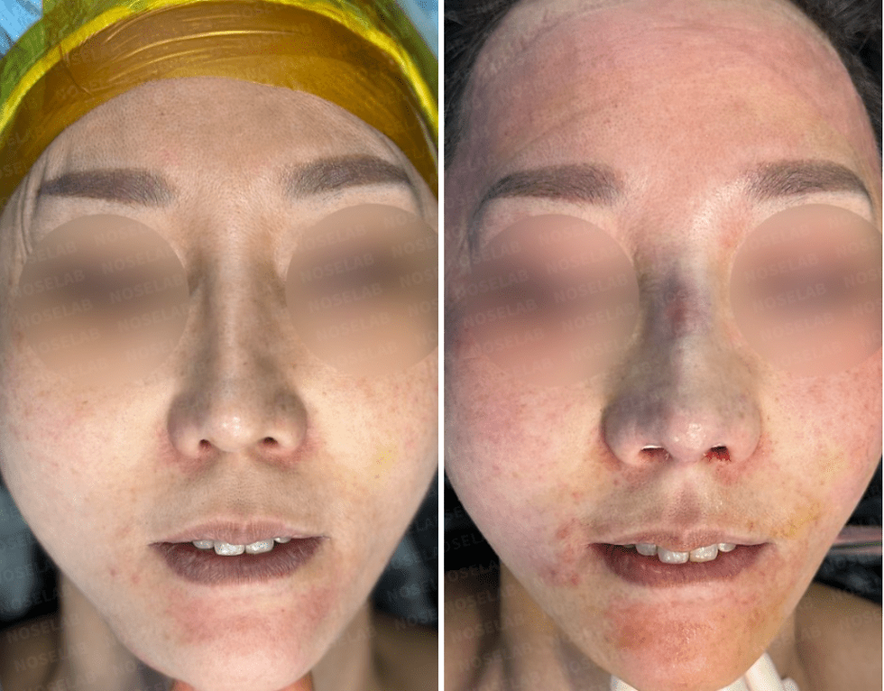Before and After Surgery Photos. Before surgery (left), after surgery (right)