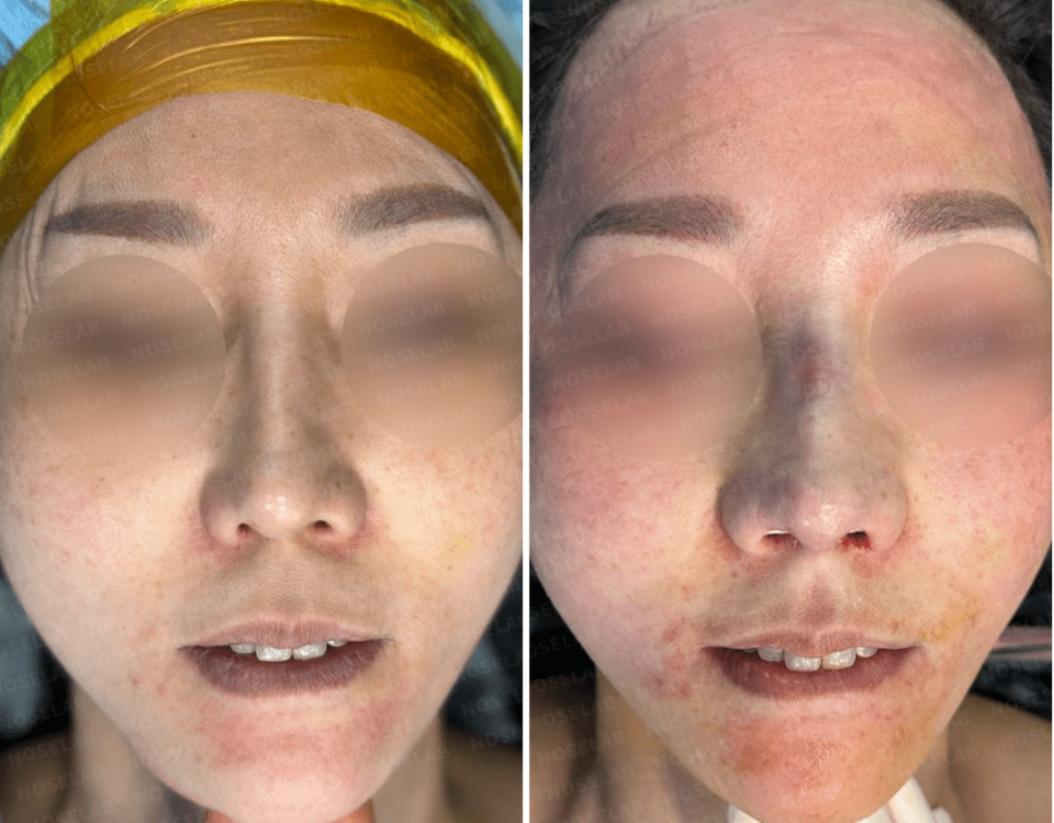 Before and After Surgery Photos. Before surgery (left), after surgery (right)