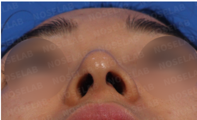 Nose hump correction Korea – preoperative nostril view showing asymmetry and tilted nose tip