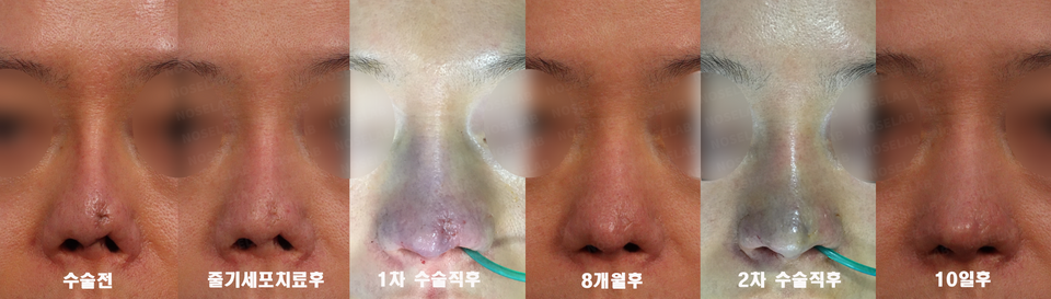 Sequential comparison of skin necrosis and contracted nose repair using autologous rib cartilage — pre-op, post stem cell treatment, first operation, 8 months, second operation, and 10 days after surgery at NoseLab Seoul.