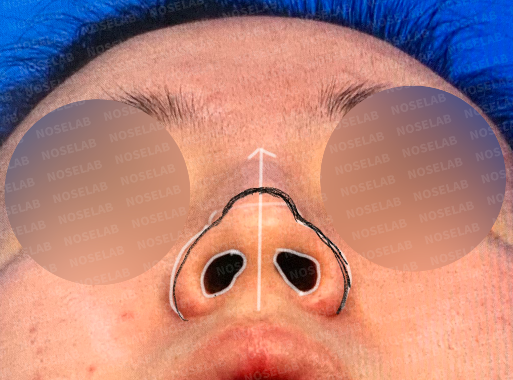 Basal view examination demonstrating nostril symmetry assessment prior to aesthetic nasal surgery