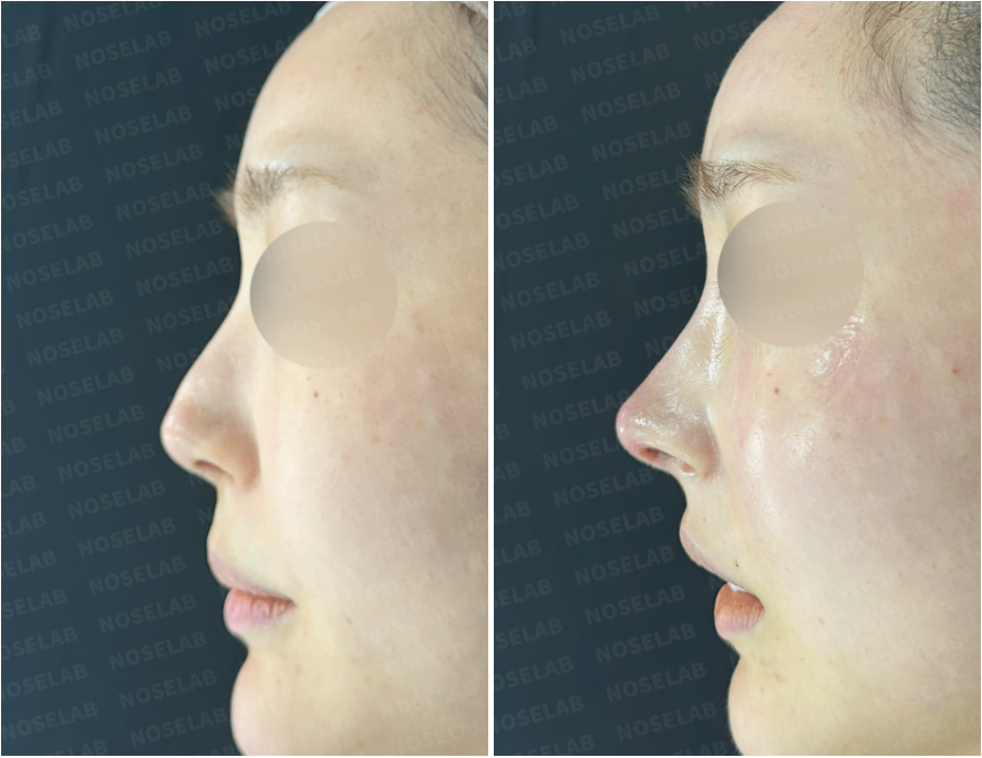 Correcting Drooping Nasal Tip and Nasal Obstruction – Before and Immediately After side view closed rhinoplasty at Nose Lab Clinic
