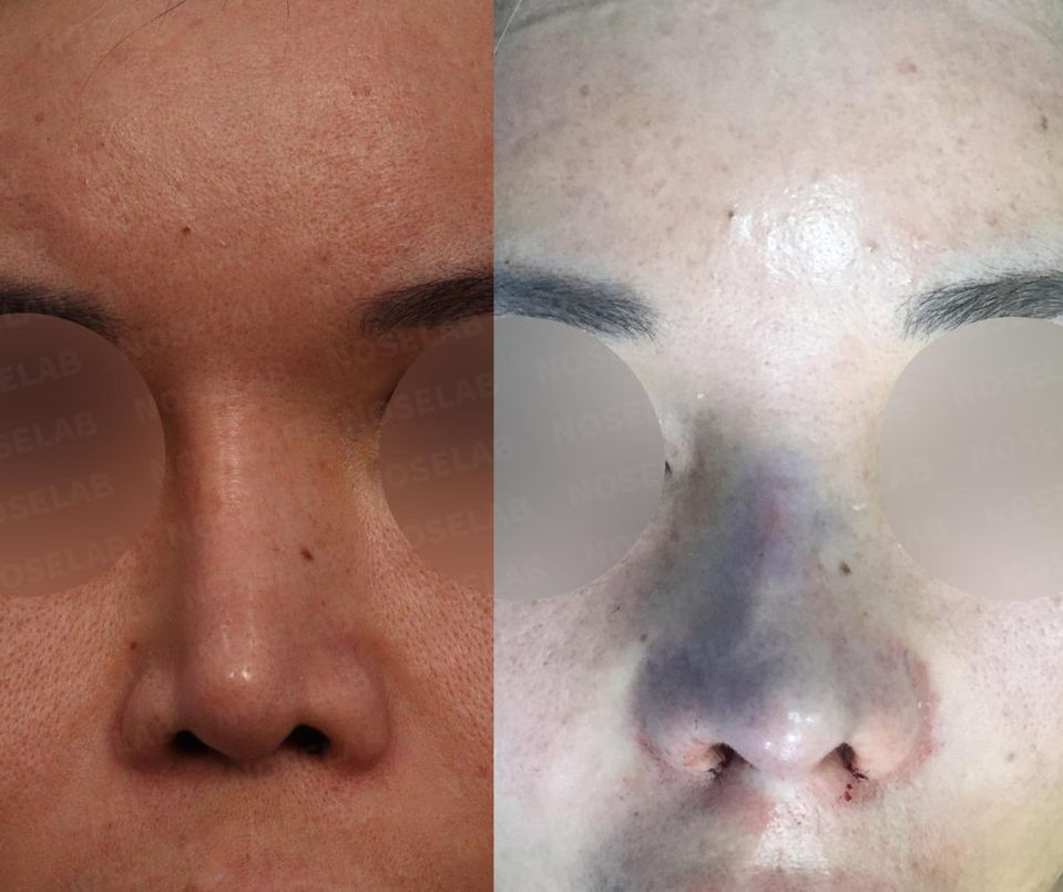 Frontal view before and after Crooked Nose Correction – Rhinoplasty Korea