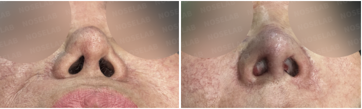 Nostril before and immediately after views showing lower nasal framework support after donor rib cartilage reconstruction.