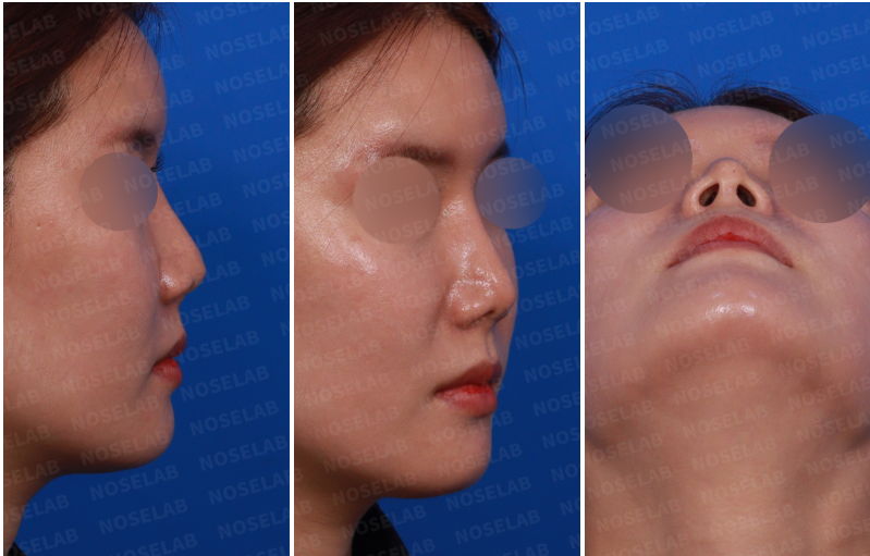 Closed rhinoplasty Korea – preoperative right side, oblique, and nostril view showing nasal tip deformity, overexposed nostrils, and asymmetry