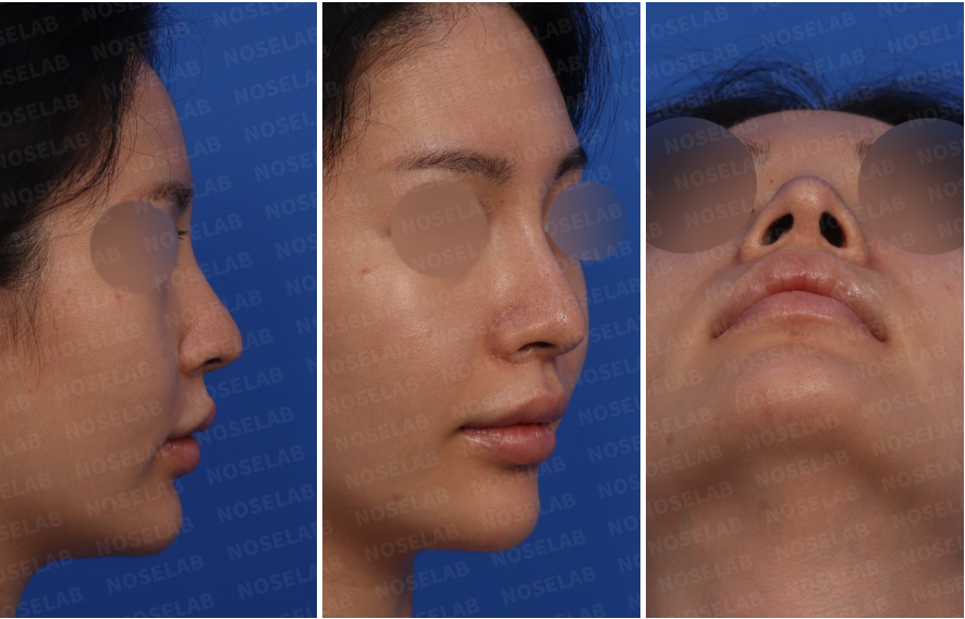 Pre-surgery design consultation photos showing the patient's right side, right oblique, and nasal base views before rhinoplasty.