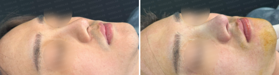 Before surgery (left), After surgery (right)