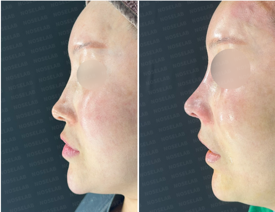 Left side profile before and immediately after contracted nose reconstruction, highlighting improved nasal tip projection and smoother dorsal contour