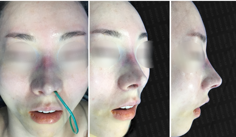 Photos taken immediately after surgery, frontal view, 45-angle view, and side profile.