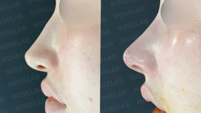 No-Implant Nose Surgery | Naturally Enhanced Nose with Autologous Rib Cartilage – Nose Lab Clinic