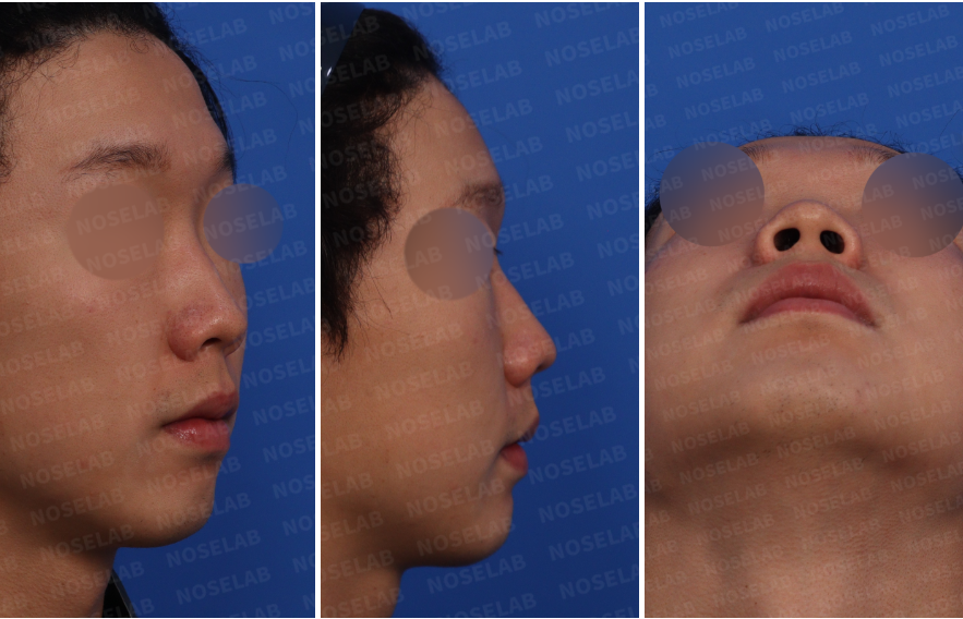 Pre-surgery consultation photos for upturned nose, small nose, and nasolabial angle correction – right oblique, right profile, and nostril views.