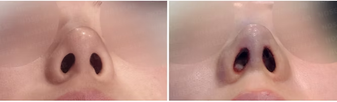 Before and immediately after surgery basal view showing reduced nostril show and improved alar symmetry following revision closed rhinoplasty with rib cartilage reconstruction.