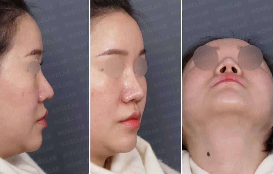 Preoperative consultation photos showing right side profile, right oblique view, and nostril view of a patient with columellar retraction and right alar cartilage deformity before revision closed rhinoplasty.