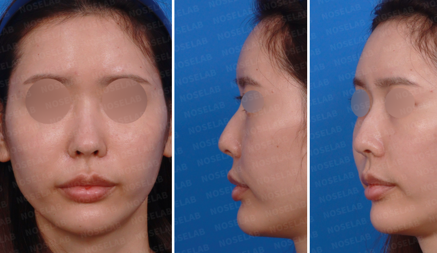 Preoperative views before autologous rib cartilage rhinoplasty showing frontal and left side profiles