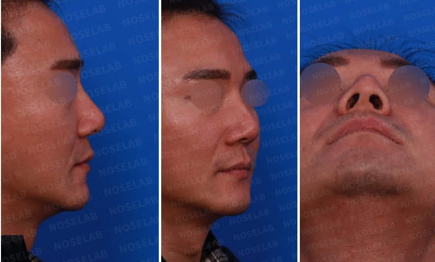 Preoperative design consultation – right side, oblique side, and nostril view photos for deviated nose correction