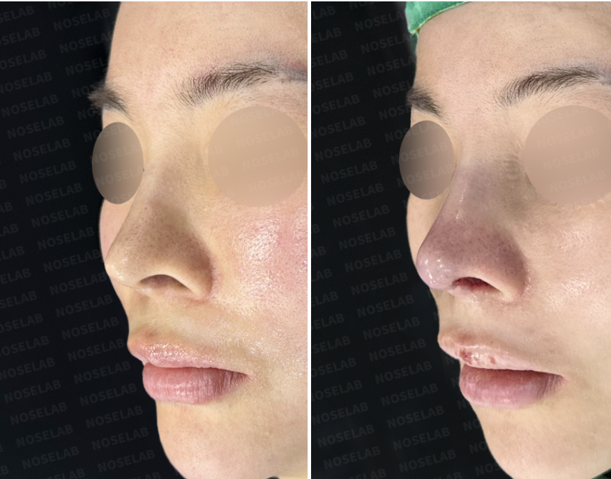 Before and immediately after surgery oblique view showing improved nasal contour and structural support following closed revision rhinoplasty with autologous rib cartilage reconstruction.