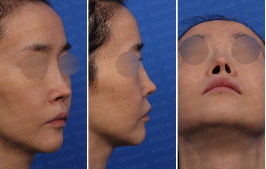 Pre-surgery consultation photos showing oblique, profile, and nostril views of a patient with nasal asymmetry before revision rhinoplasty.