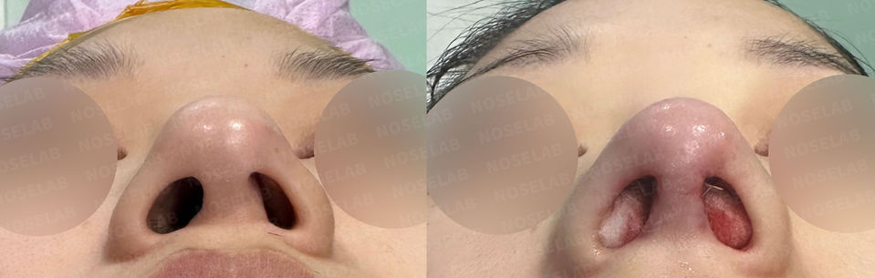 Basal view before and after Deviated and Droopy Nose Correction – Closed Rhinoplasty Korea