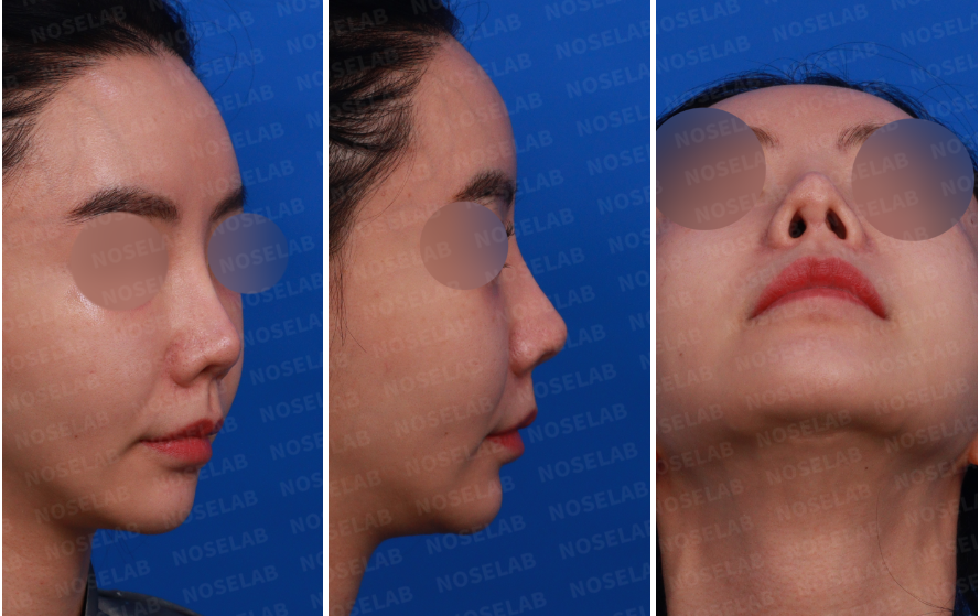 Repeated Dermal Absorption Nose Revision – Preoperative Right Oblique, Side, and Nostril View Photos