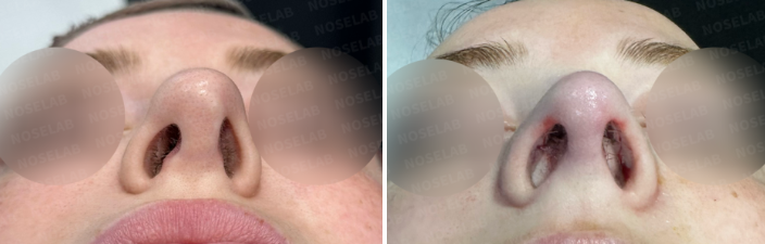 Nostrils before surgery (left) after surgery (right)